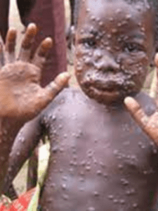 Monkeypox flare-up needs a unified reaction, says WHO Africa